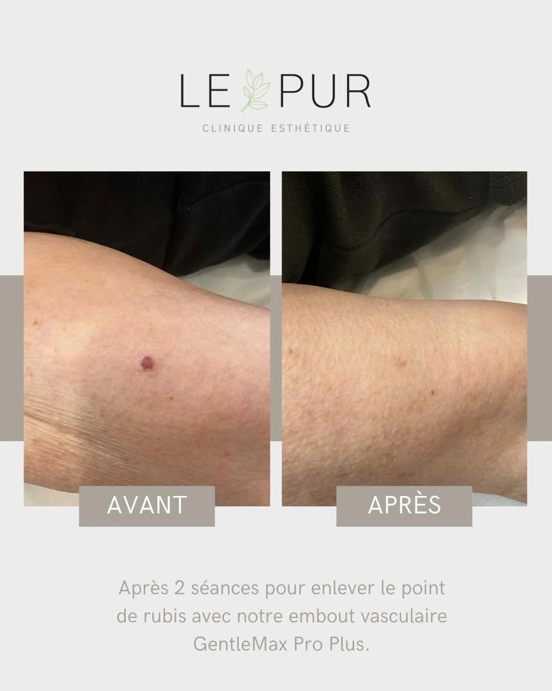 Avant/Après traitement d'un point de rubis avec l'embout vasculaire GentleMax Pro Plus