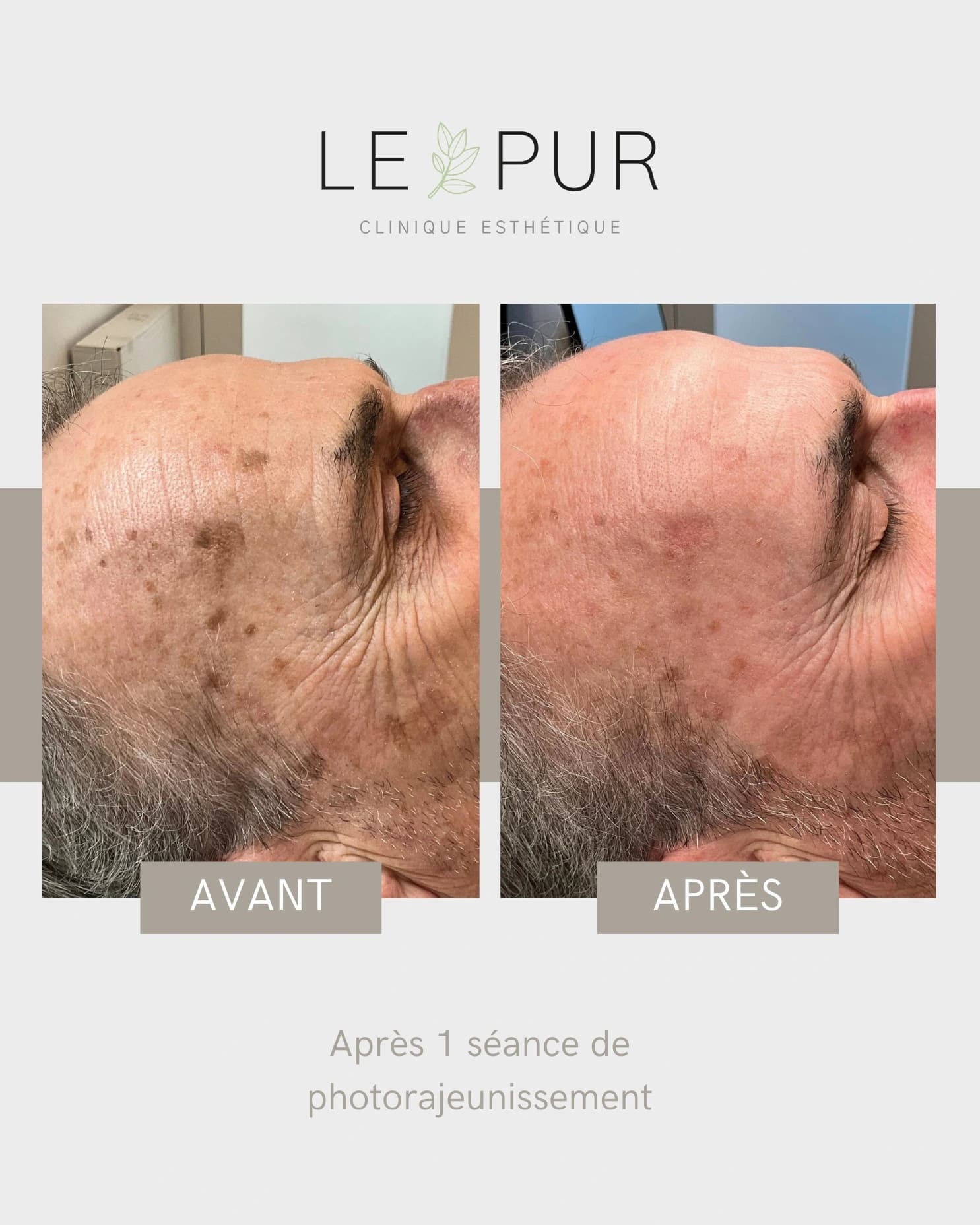 Avant/Après photorajeunissement - Réduction des taches pigmentaires