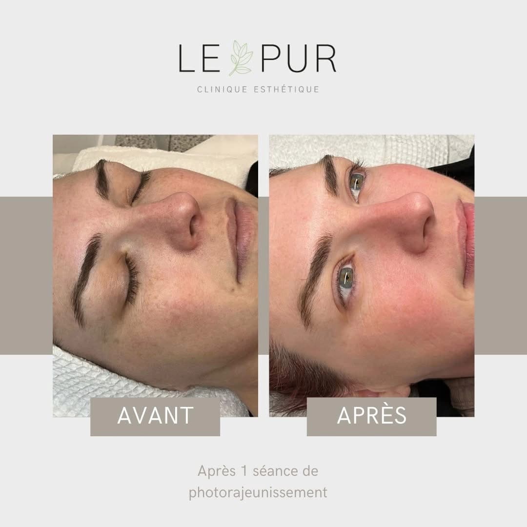 Avant/Après photorajeunissement - Uniformisation du teint