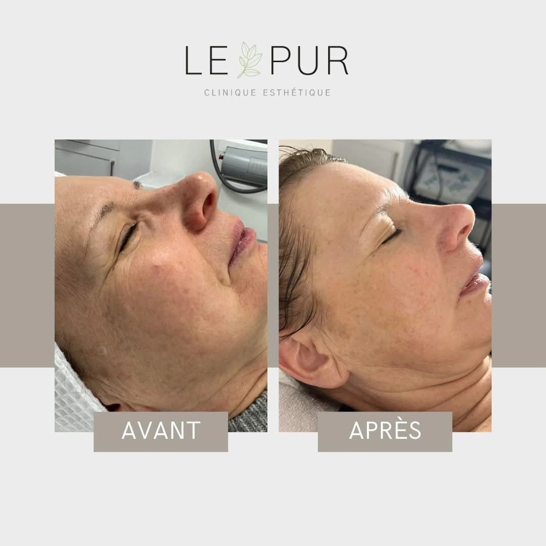Avant/Après resurfaçage Bloomea - Amélioration de la texture de la peau