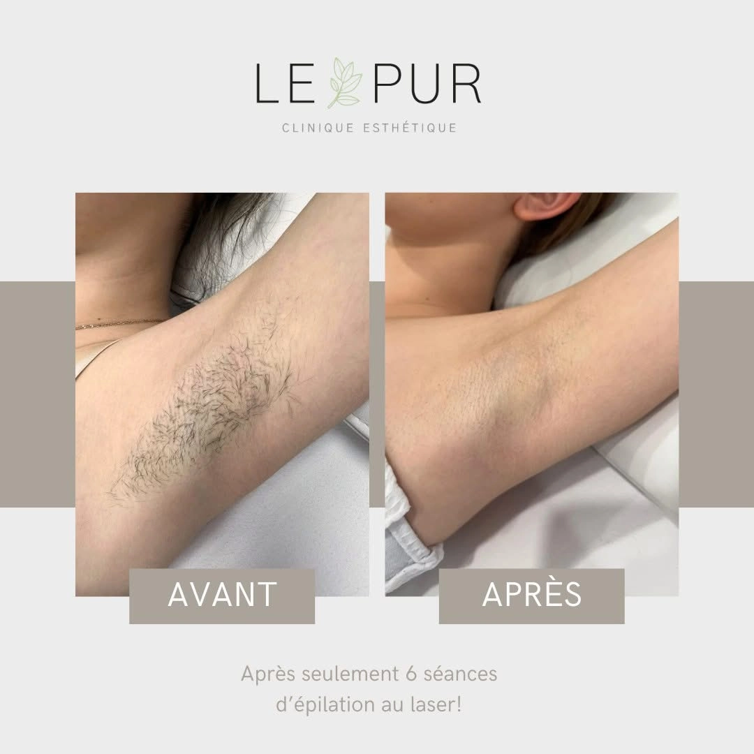 Avant/Après épilation laser des aisselles - 6 séances