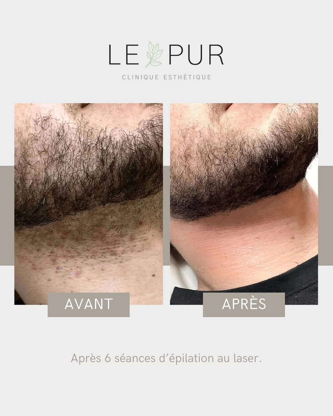 Avant/Après épilation laser du cou et menton - 6 séances
