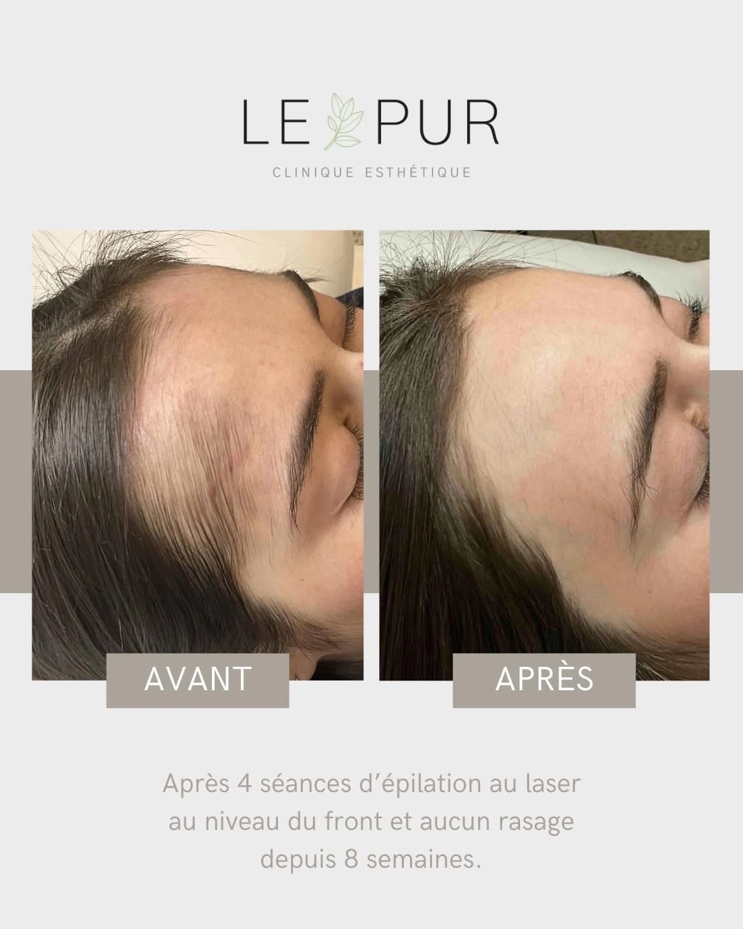 Avant/Après épilation laser du front - 4 séances