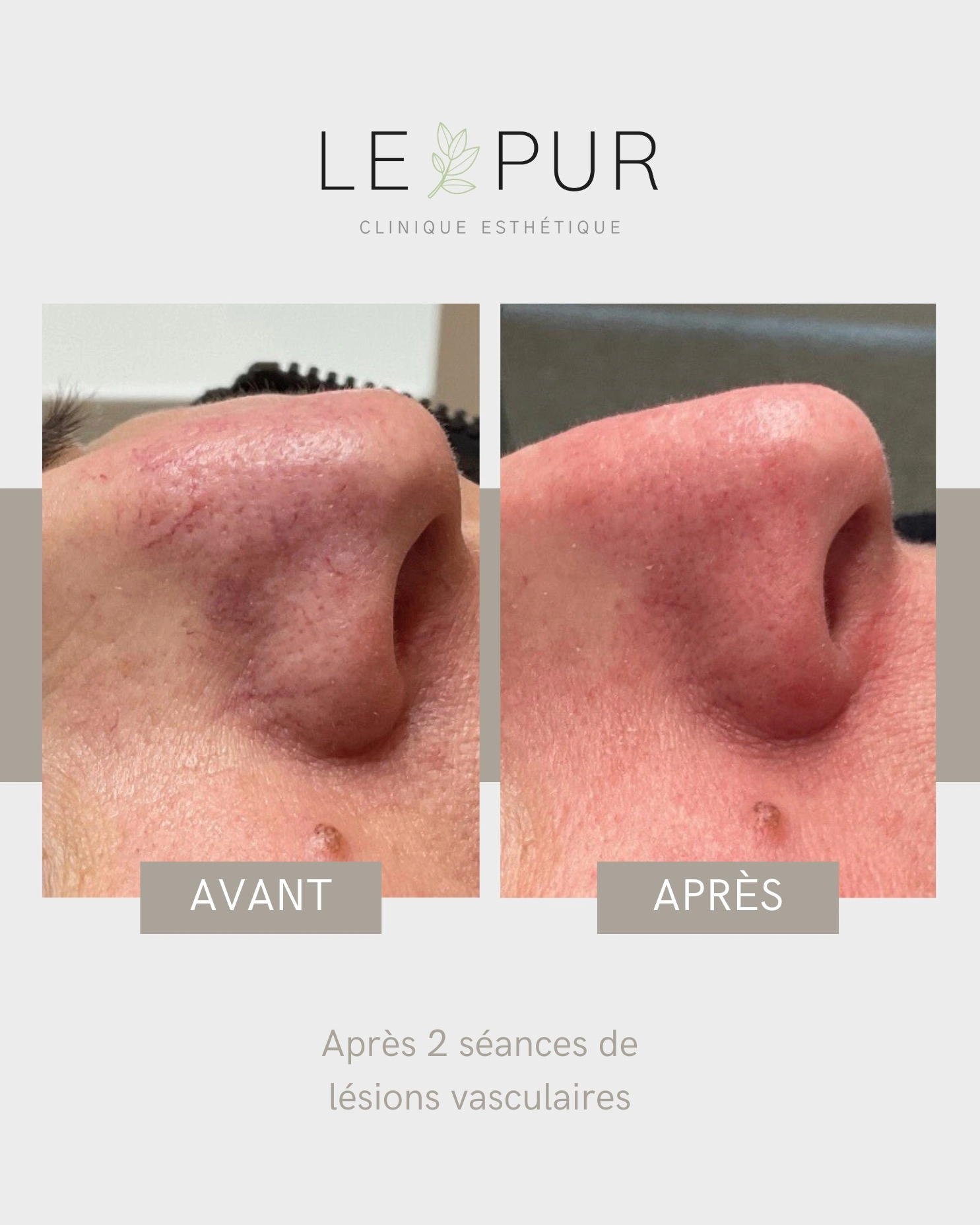 Avant/Après traitement des lésions vasculaires - Réduction des rougeurs