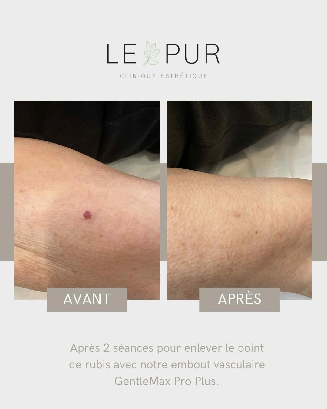 Avant/Après traitement d'un point de rubis avec l'embout vasculaire GentleMax Pro Plus