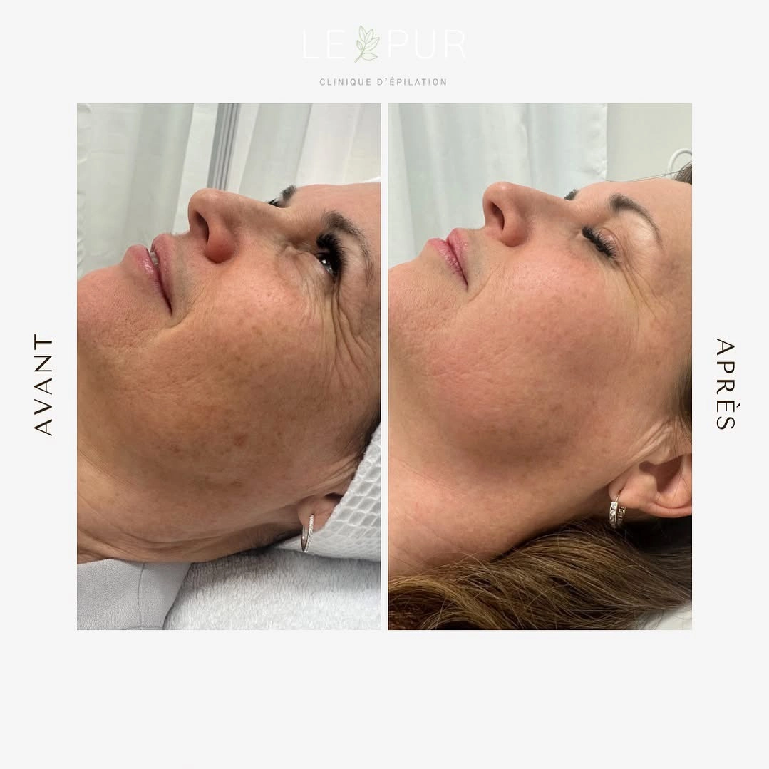 Avant/Après resurfaçage Bloomea - Réduction des rides et ridules